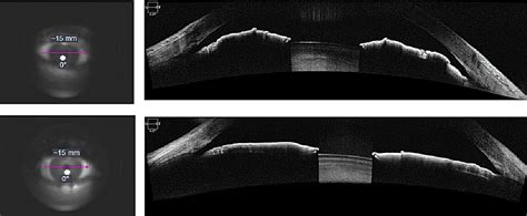 what is oct in ultrasound